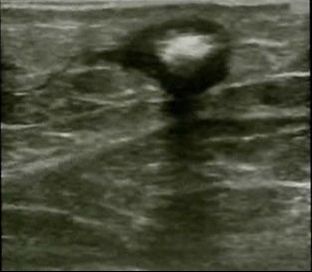 appearance of foam under ultrasound